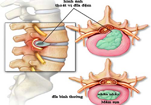 thoát vị đĩa đệm có đi bộ được không và cách điều trị