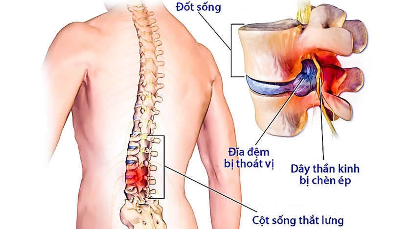 Thoát vị đĩa đệm có quan hệ được không