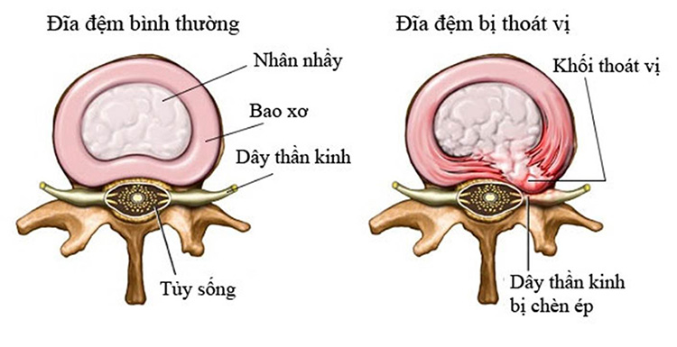 Thoát vị đĩa đệm là gì và những đối tượng nào dễ mắc bệnh