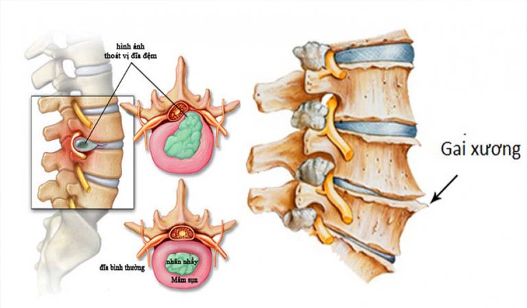 Thoát vị đĩa đệm - Nguyên nhân cách phòng và điều trị