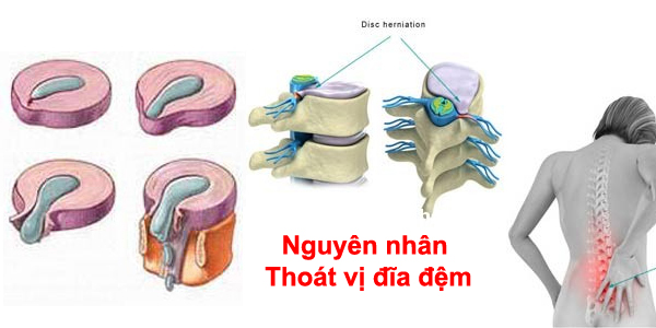 Thoát vị đĩa đệm nguyên nhân và cách điều trị đúng cách