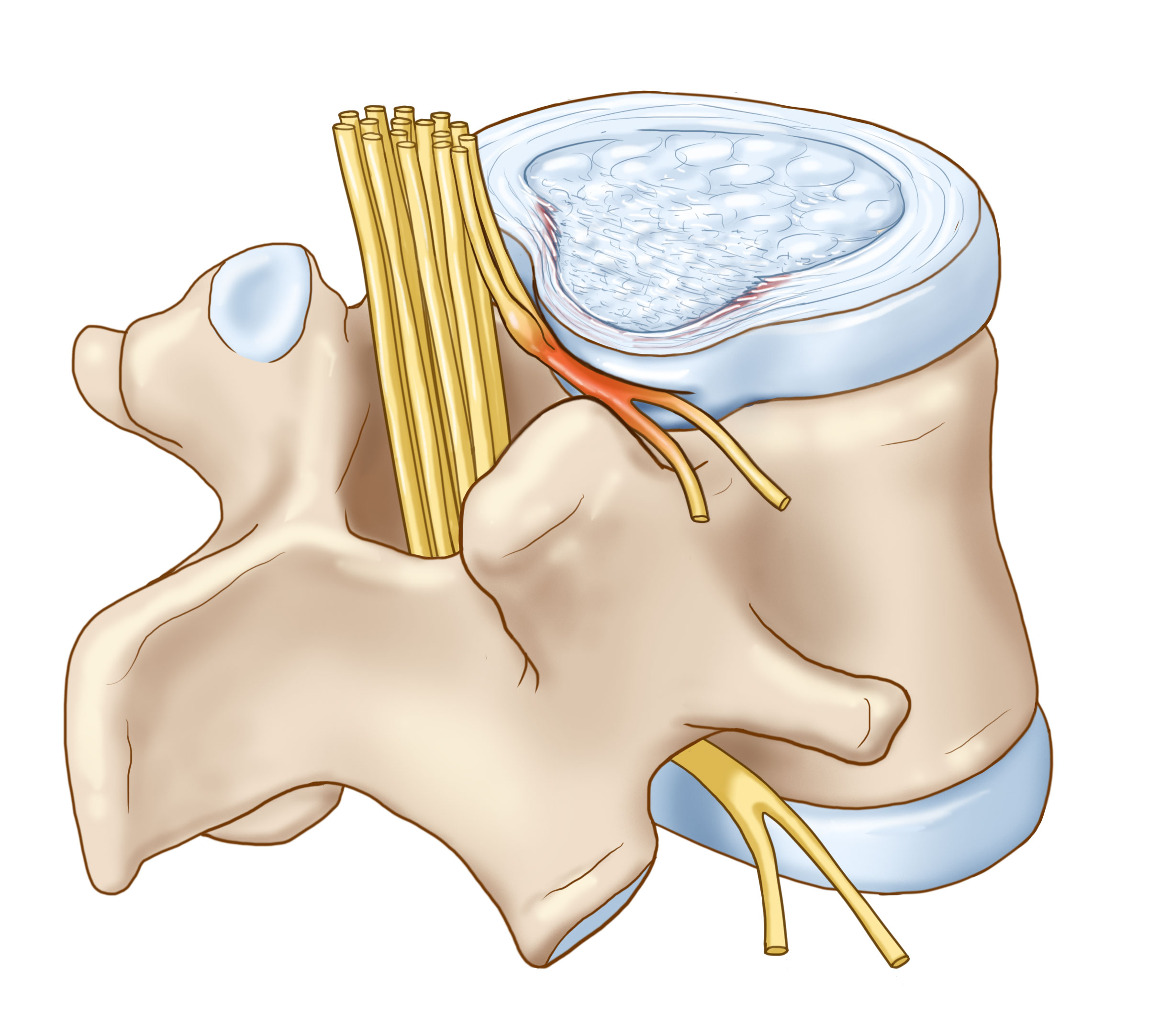 Thoát vị đĩa đệm nguyên nhân và cách điều trị