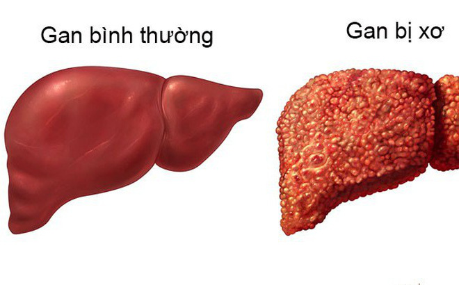 Thực đơn cho người bệnh gan như thế nào