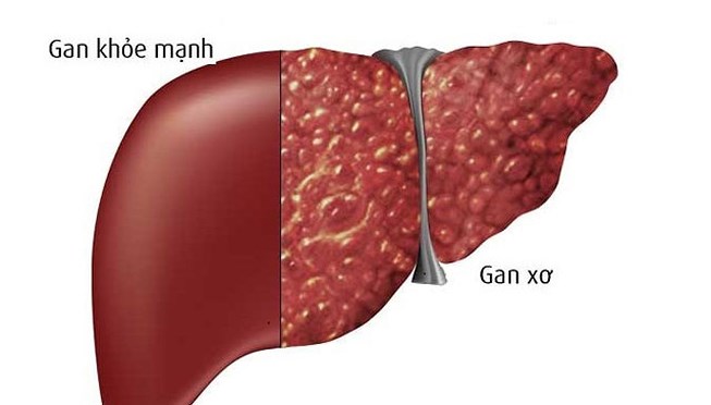 Thực đơn cho người bệnh xơ gan như thế nào