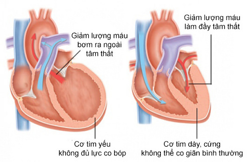 thực phẩm chức năng cho người suy tim loại nào tốt