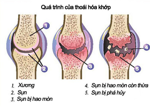 Thực phẩm chức năng về xương khớp loại nào tốt