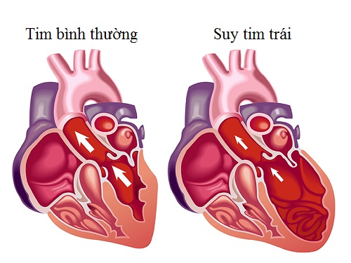 Thuốc bổ cho người suy tim loại nào tốt