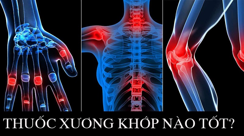 Thuốc bổ xương khớp tốt nhất 