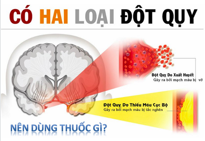 Thuốc chống đột quỵ của Mỹ loại nào tốt