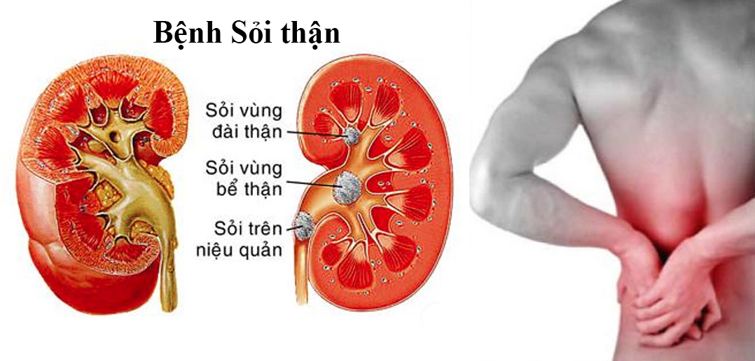 Thuốc chữa sỏi thận hiệu quả nhất hiện nay mua ở đâu