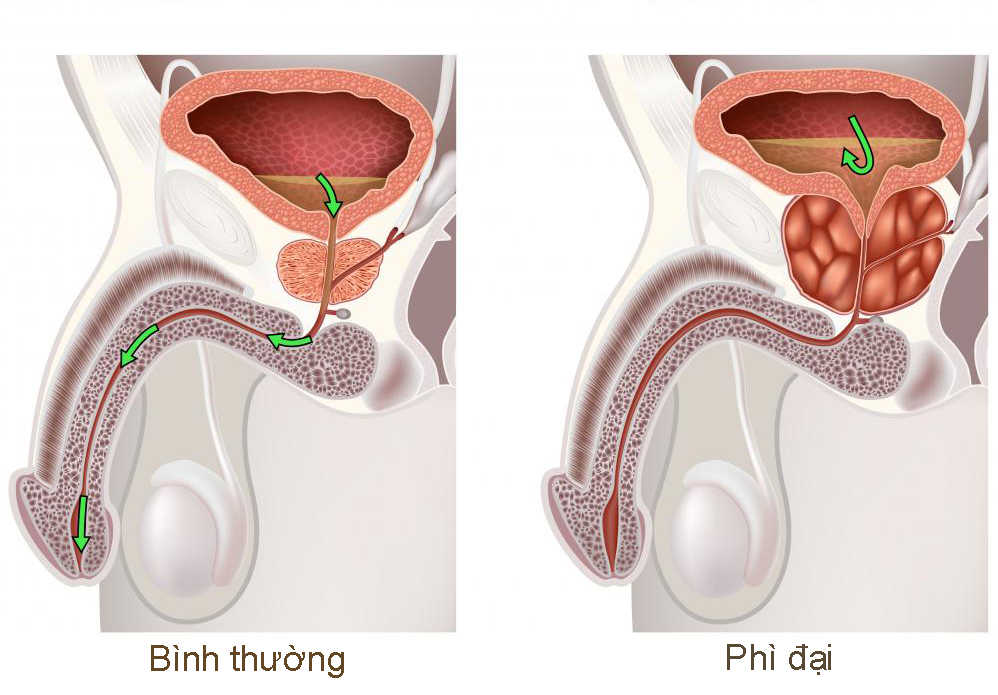 thuốc đặc trị phì đại tiền liệt tuyến 