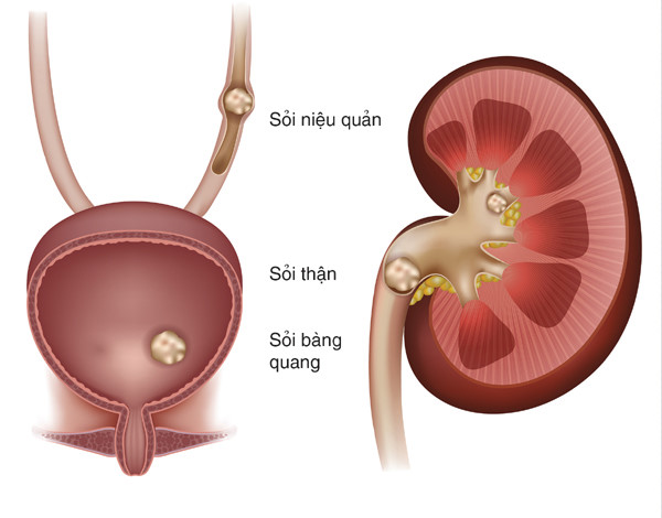 Thuốc đánh tan sỏi thận loại nào tốt nhất