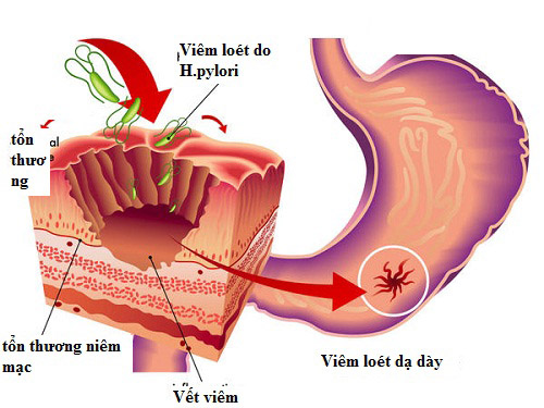 Thuốc đau dạ dày của Mỹ loại nào tốt