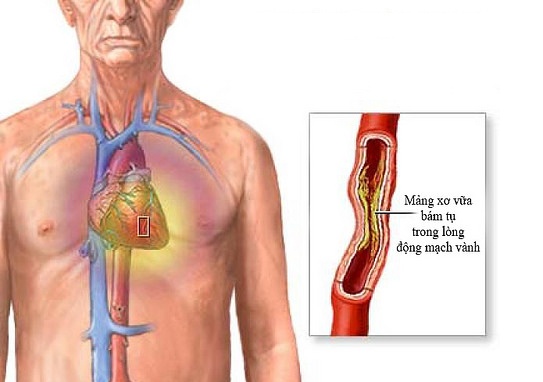 Thuốc điều trị hẹp mạch vành loại nào tốt 