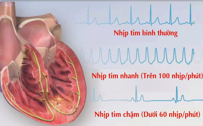 Thuốc điều trị rối loạn nhịp tim