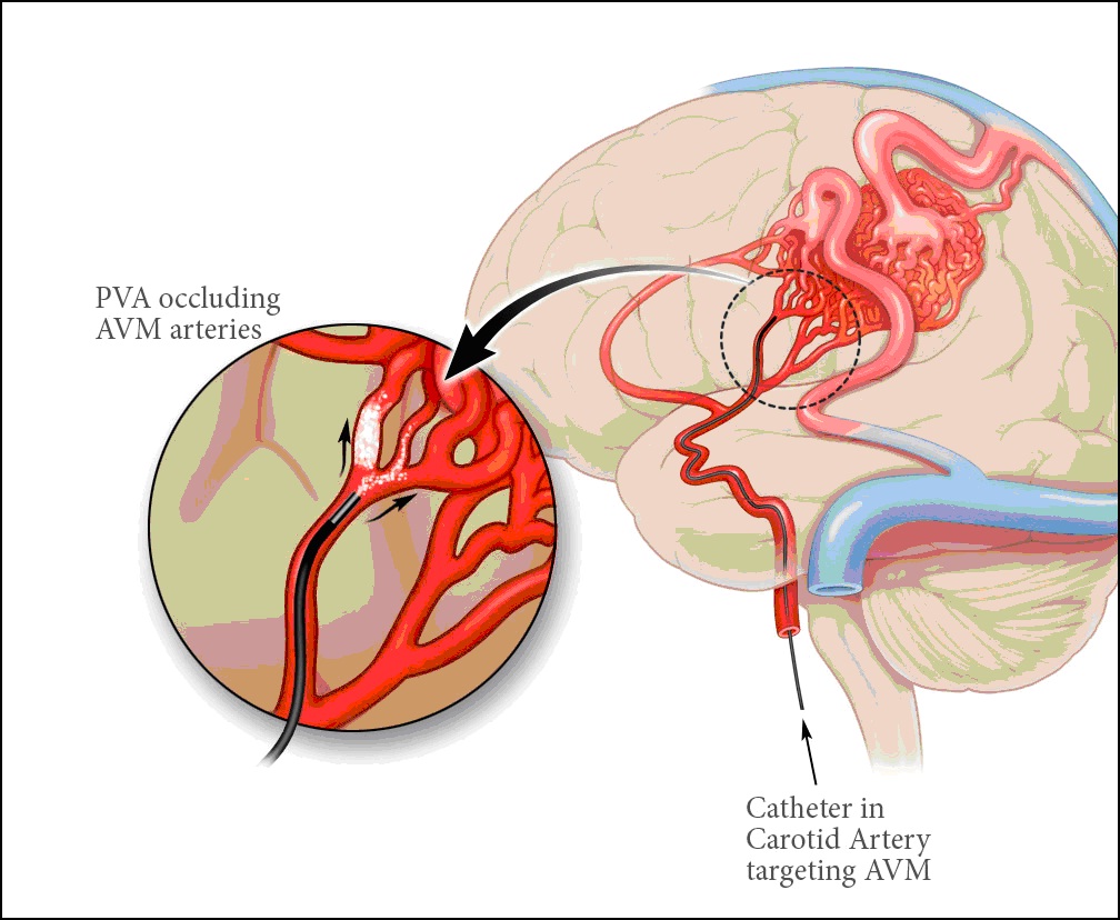 Сосудистая аномалия. Эмболизация АВМ сосудов головного мозга. АВМ мальформация сосудов головного мозга. Эмболизация мальформации. Артериовенозные мальформации сосудов головного мозга.