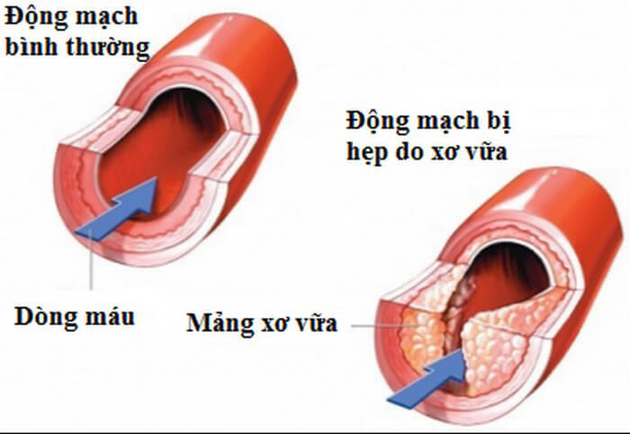 Thuốc điều trị xơ vữa mạch vành an toàn hiệu quả