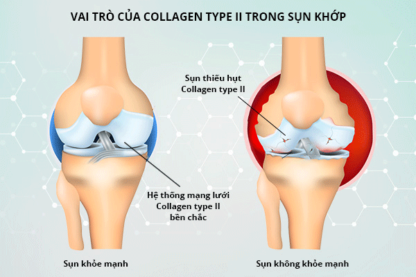 Thuốc hỗ trợ điều trị thoái hóa cột sống loại nào tốt 