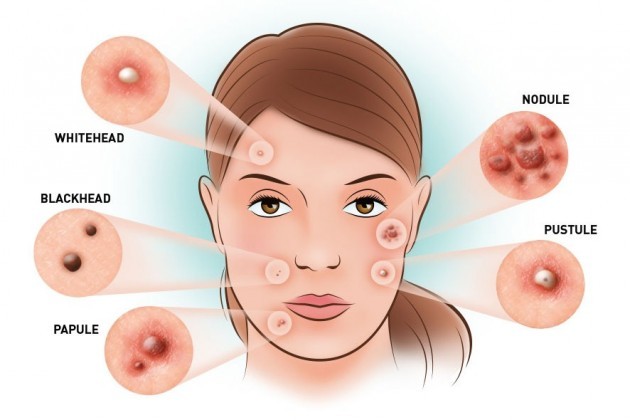 Thuốc nội tiết tố nữ trị mụn loại nào tốt 