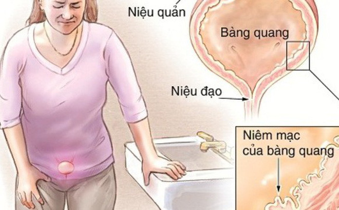 Tiểu đêm nhiều lần ở phụ nữ là bệnh gì 