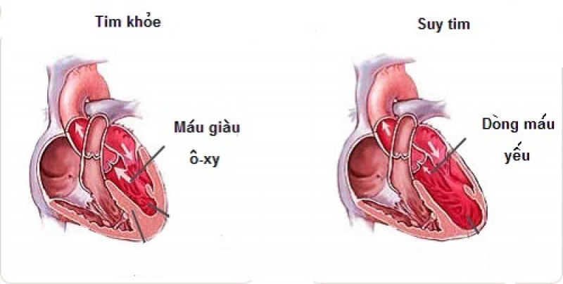 Tim đập nhanh khó thở là bệnh gì và cách chữa trị ra sao