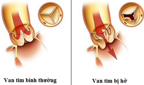 Tim đập nhanh khó thở là bệnh gì và cách chữa trị ra sao