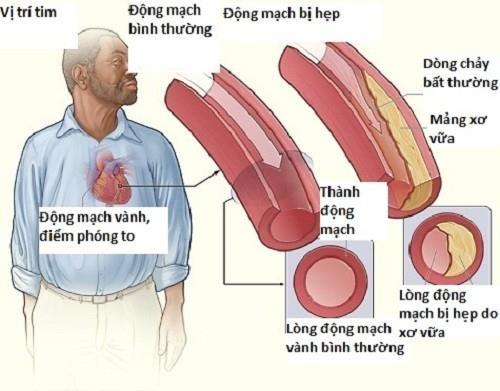 Triệu chứng của bệnh mạch vành như thế nào