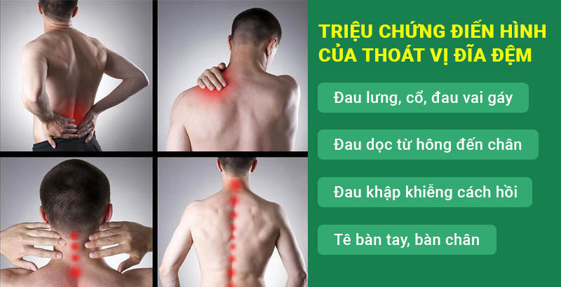 Triệu chứng của thoát vị đĩa đệm như thế nào