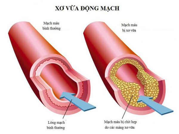 Triệu chứng tai biến mạch máu não nhẹ