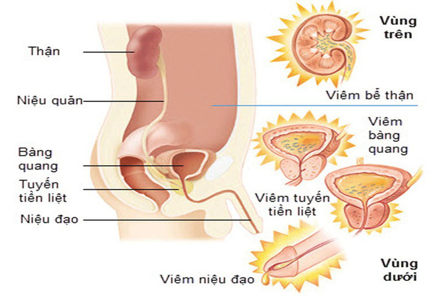 Triệu chứng viêm đường tiết niệu là gì 