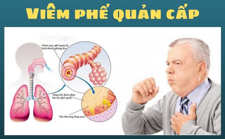 Triệu chứng viêm phế quản cấp và cách phòng bệnh hiệu quả