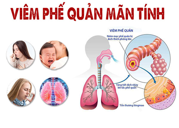 Triệu chứng viêm phế quản mãn tính