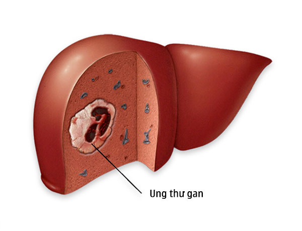 u gan ác tính có chữa được không