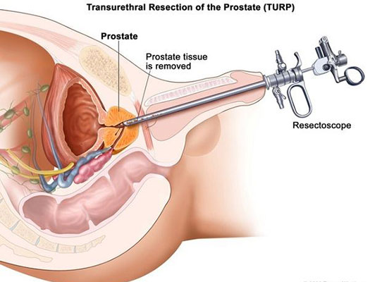 U xơ tiền liệt tuyến có nên mổ không và mổ ở đâu