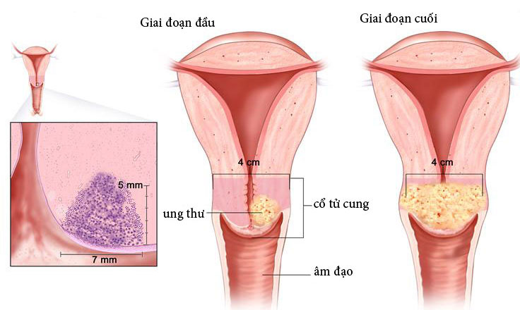 Ung thư buồng trứng có chữa khỏi được không 