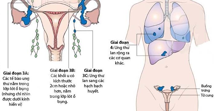 Ung thư buồng trứng giai đoạn cuối như thế nào