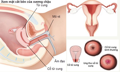 Ung thư cổ tử cung có chết không