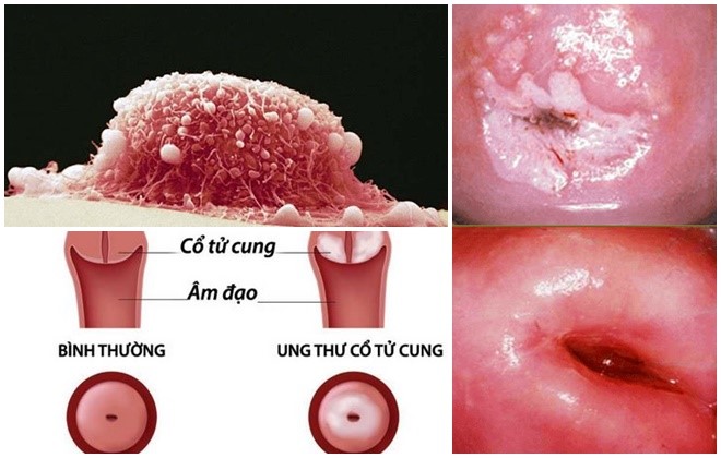 Ung thư cổ tử cung có nguy hiểm không và cách phòng bệnh ra sao