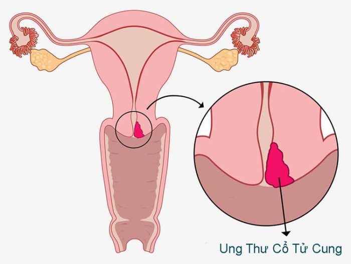 Ung thư cổ tử cung có nguy hiểm không và cách phòng bệnh ra sao