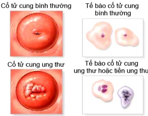 Ung thư cổ tử cung có nguy hiểm không và cách phòng bệnh ra sao