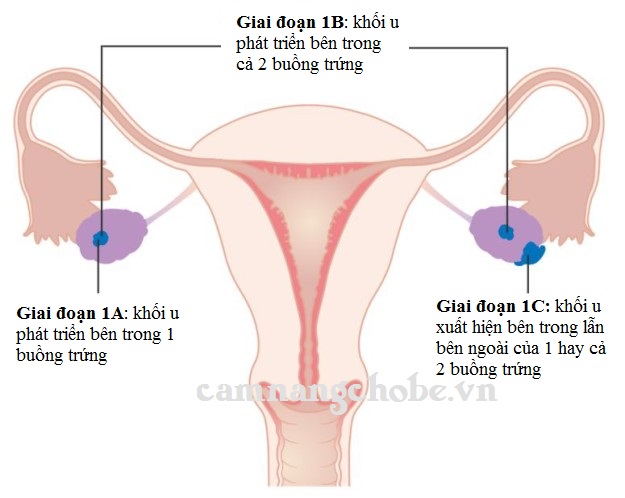 Ung thư cổ tử cung giai đoạn đầu như thế nào