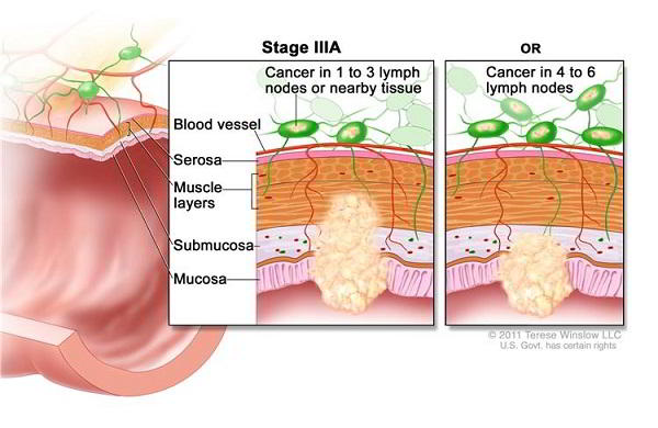 Ung thư dạ dày giai đoạn 3 như thế nào và cách phòng điều trị bệnh
