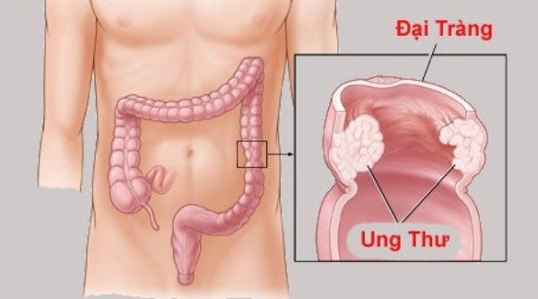 ung thư đại tràng và cách phòng bệnh