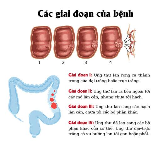ung thư đại tràng và cách phòng bệnh