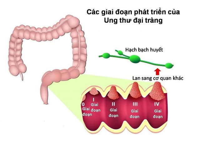 Ung thư di căn hạch