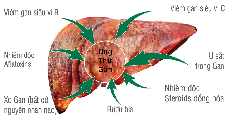 Ung thư gan cách phòng và điều trị bệnh