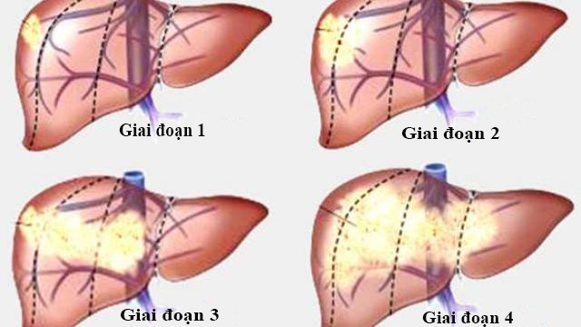 Ung thư gan giai đoạn cuối sống được bao lâu 