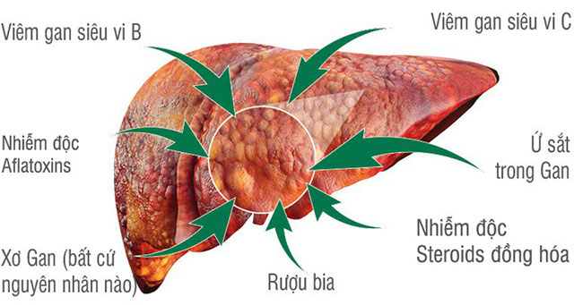 Ung thư gan sống được bao lâu và cách phòng tránh như thế nào