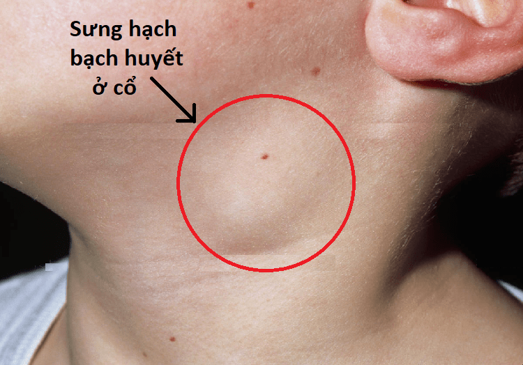 Ung thư máu có lây không và cách phòng bệnh