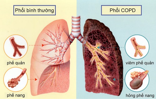ung thư phổi có bao nhiêu giai đoạn và cách phòng tránh bệnh